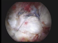 Beispiel für eine arthroskopisch genähte Rotatorenmanschette